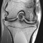 Radiograph of a goat kneedGEMRIC sequence of a goat knee (3 Tesla)